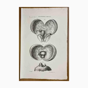 Ottavio Muzzi, Prostate Diseases, Lithograph, 1843-ZCI-2030167