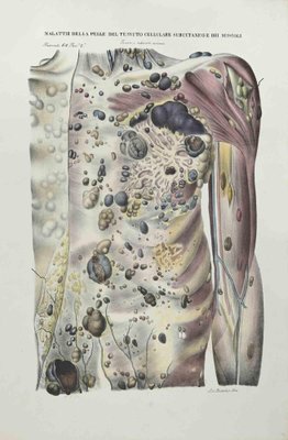 Ottavio Muzzi, Skin Diseases of Subcutaneous Cell Tissue and Muscles, Lithograph, 1843-ZCI-2029987