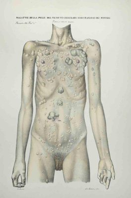 Ottavio Muzzi, Skin Diseases of Subcutaneous Cell Tissue and Muscles, Lithograph, 1843-ZCI-2029986