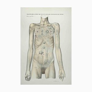 Ottavio Muzzi, Skin Diseases of Subcutaneous Cell Tissue and Muscles, Lithograph, 1843-ZCI-2029986