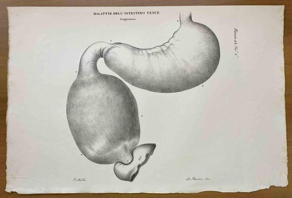 Ottavio Muzzi, Small Intestine Disease, Lithograph, 1843-ZCI-2030146