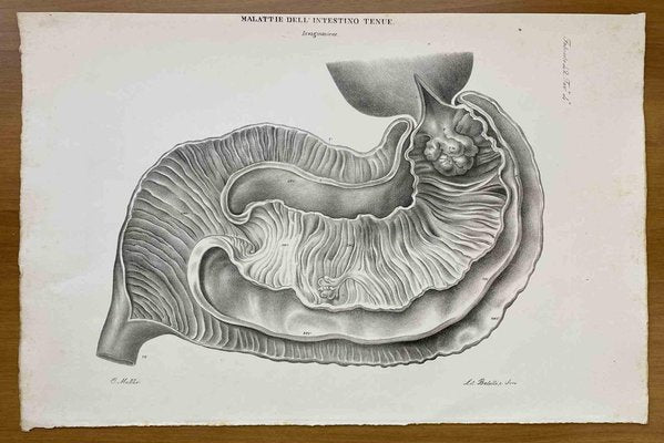 Ottavio Muzzi, Small Intestine Disease, Lithograph, 1843-ZCI-2030155