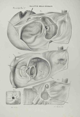 Ottavio Muzzi, Stomach Diseases, Lithograph, 1843-ZCI-2030002