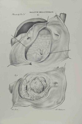 Ottavio Muzzi, Stomach Diseases, Lithograph, 1843-ZCI-2030001