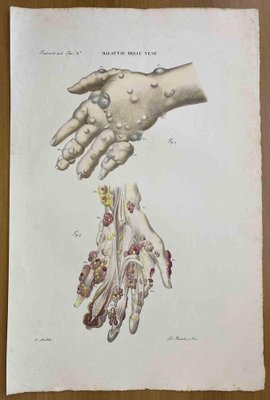 Ottavio Muzzi, Vein Diseases, Lithograph, 1843-ZCI-2030130