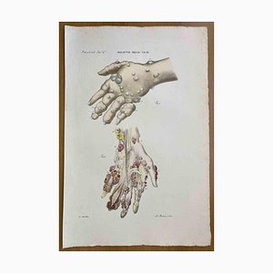 Ottavio Muzzi, Vein Diseases, Lithograph, 1843-ZCI-2030130