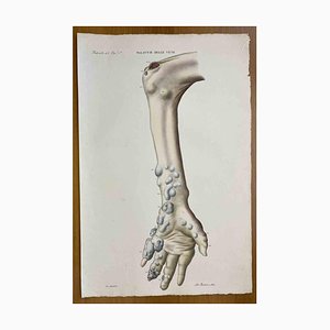 Ottavio Muzzi, Vein Diseases, Lithograph, 1843-ZCI-2030153